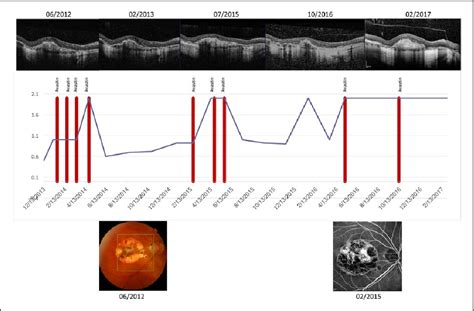 Figure 2 from Long-term results of intravitreal bevacizumab and dexamethasone for the treatment ...