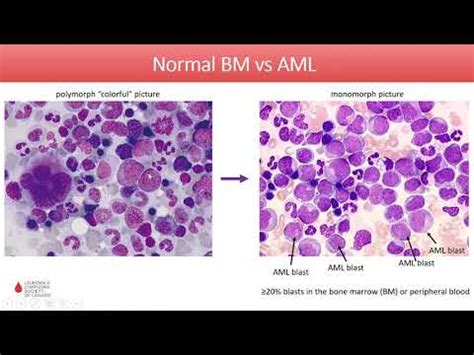 Acute Myeloid Leukemia - Diagnosis and Treatment in 2020 • Video ...