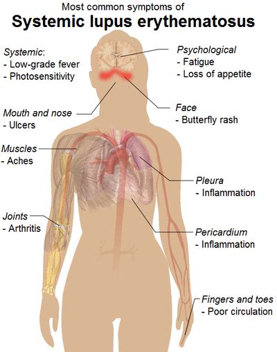 Systemic Lupus Erythematosus - Physiopedia