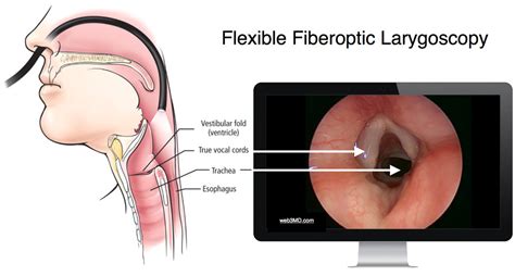 Flexible-fiberoptic-laryngoscopy - Fort Worth ENT & Sinus