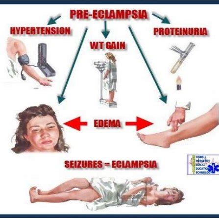 Signs and Symptoms of pre-eclampsia | Download Scientific Diagram