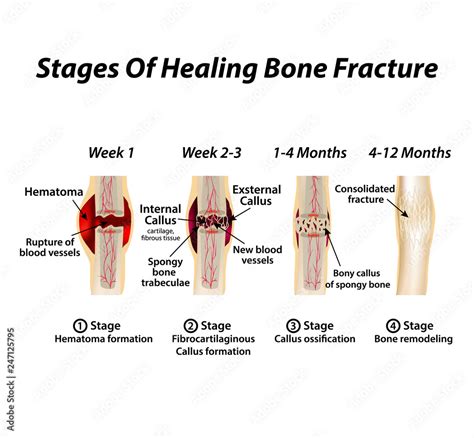 Stages Of Healing Bone Fracture. Formation of callus. The bone fracture ...