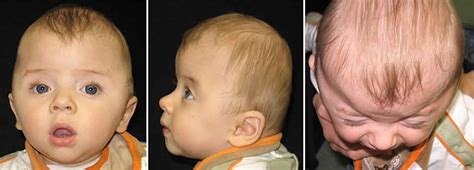 Craniosynostosis causes, symptoms, treatment & craniosynostosis surgery