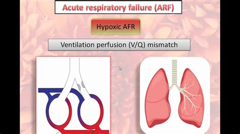 13 - Indications for mechanical ventilation (clinical approach) - YouTube