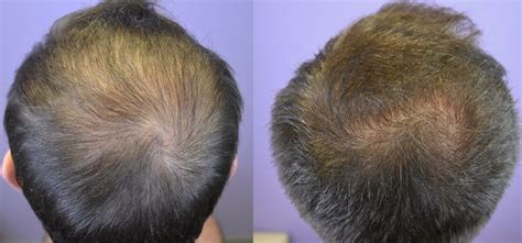 Minoxidil Results After 1 Year - Wimpole Clinic