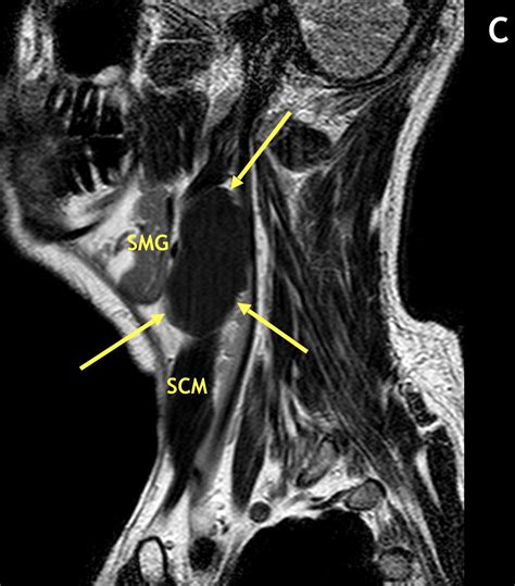 Branchial Cleft Cyst (BCC) - MRI Online