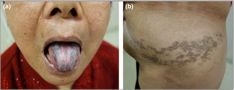 Lichen Planus On Tongue