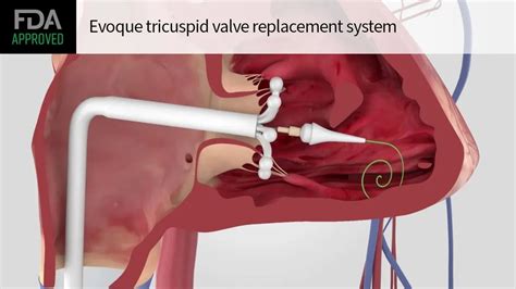 FDA Approves Edwards Lifesciencesâ Evoque Tricuspid Valve Replacement System: A Groundbreaking ...