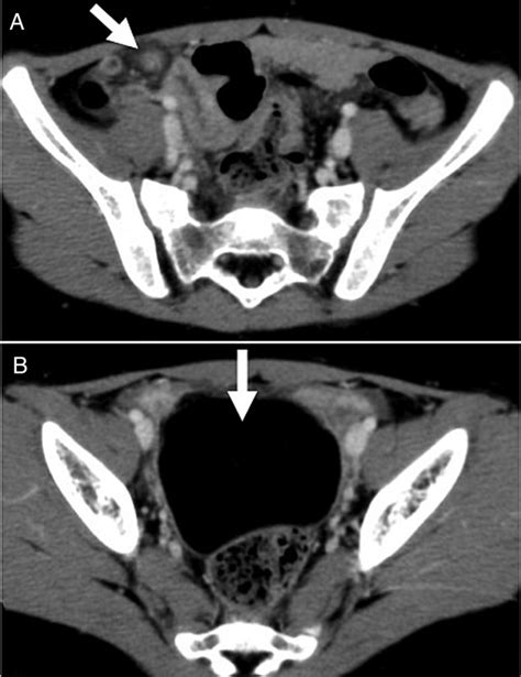 Contrast-enhanced CT scan showed (A) torsion of the omentum, which was ...