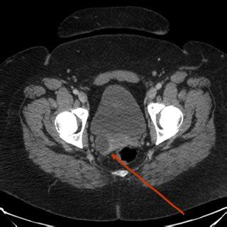 CT urogram showing isthmus of the horseshoe kidney with dilated upper ...