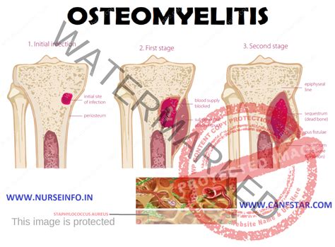 OSTEOMYELITIS - Nurse Info