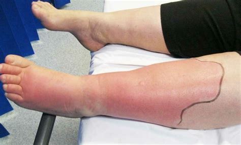 What is Cellulitis? Its Causes, Symptoms, Treatment - Bee Healthy