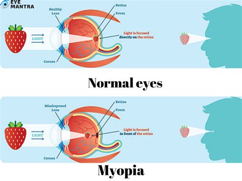 Myopia: Symptoms, Causes and Treatment | Eyemantra