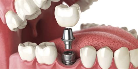 Dental Implants Turkey Free Consultation- Medic istanbul