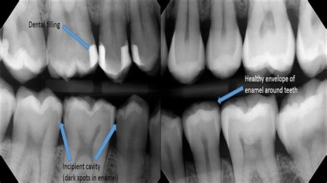 What Does A Cavity Look Like Molar - change comin