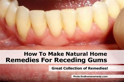 How To Make Natural Home Remedies For Receding Gums