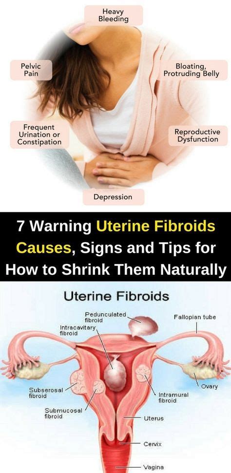 Here Are 7 Warning Uterine Fibroids Causes, Signs & Tips For How To ...