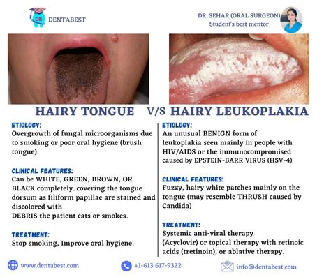 HAIRY TONGUE Vs HAIRY LEUKOPLAKIA : r/INBDE