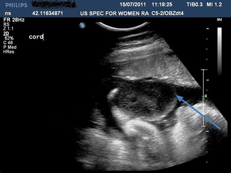 Presentation of an umbilical cord cyst with a... | F1000Research