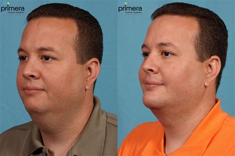 Buccal Fat Removal Before and After Pictures Case 73 | Orlando, Florida | Primera Plastic Surgery