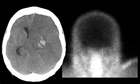 Apnea test for brain death diagnosis | STROKE MANUAL