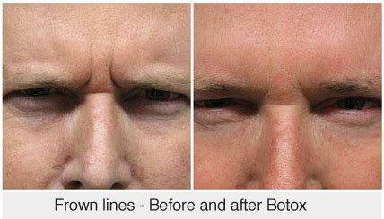 How To Reduce And Prevent Frown Lines | Face Clinic London