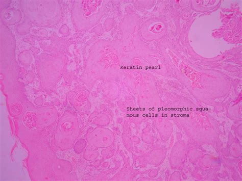 Squamous cell carcinoma – Histopathology.guru