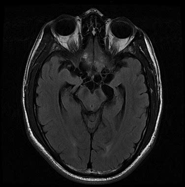 T2 axial flair MRI demonstrating suprasellar and prepontine cistern... | Download Scientific Diagram