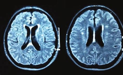 Brain MRI exam with hyperintense T2 signal on periventricular white... | Download Scientific Diagram