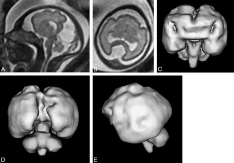 Holoprosencephaly Ultrasound