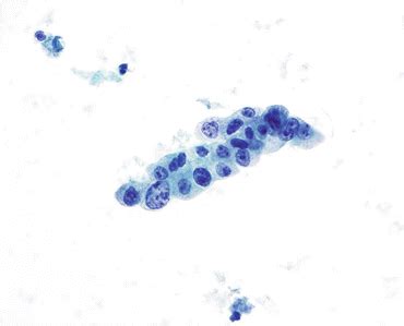 Atypical Urothelial Cells (AUC) | Basicmedical Key