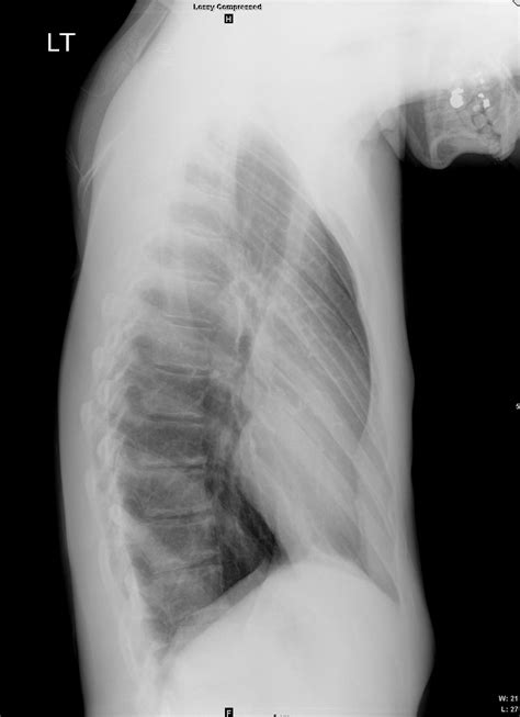 000 Pectus Excavatum | Lungs