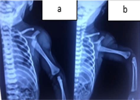 Figure 2 from Brachial Plexus Birth Injury due to Proximal Humeral Physeal Separation | Semantic ...