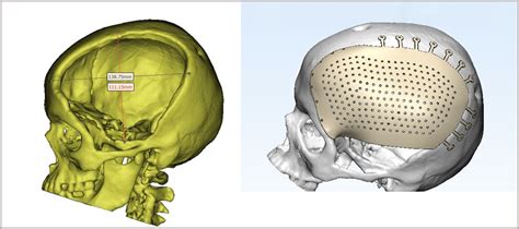 Cranial Implants - 3DIncredible