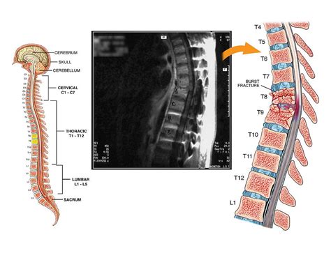 Burst Fractures Of The Thoracic Spine Photograph by John T. Alesi