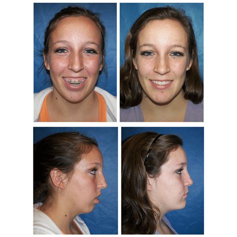 Before and After Photos Maxillofacial Surgery