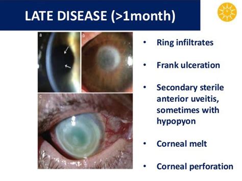 Acanthamoeba Corneal Ulcer