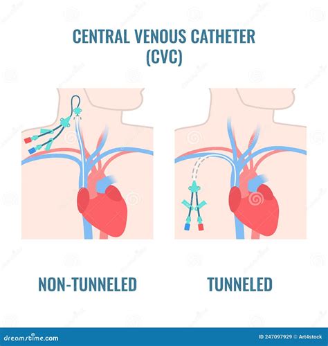 Central Line Venous Catheter Types On Male Body Cartoon Vector | The Best Porn Website