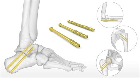 Cannulated Screw System | Acumed