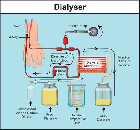 Dialysis Complete Information About Dialysis And Its