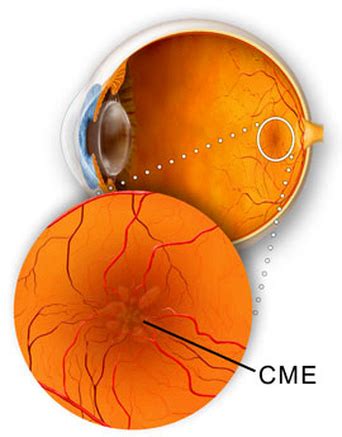 Cystoid Macular Oedema - Information on Eye Conditions