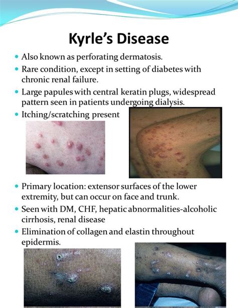 Kyrle Disease