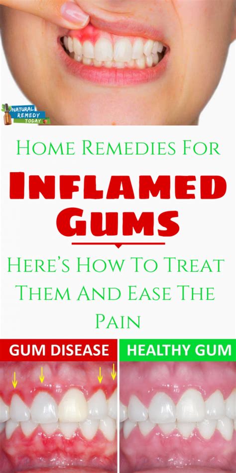 swollen gums remedy Home remedies for gum swelling:top 10 natural ...