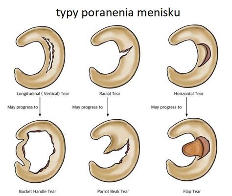 Poranenie menisku - Koleno - ORTOPEDICKÁ A TRAUMATOLOGICKÁ AMBULANCIA