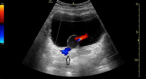 Cureus | Ureterocele Diagnosed With Point-of-Care Ultrasound