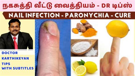 நகசுத்தி வந்தால் குணமாக வீட்டு வைத்தியம்|nail skin infection home remedies paronychia dr ...