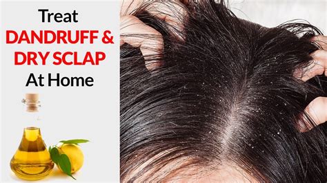 Home remedies for dandruff - minefas