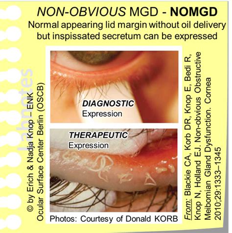 Meibomian Gland Dysfunction (MGD) — Ocular Surface Center Berlin