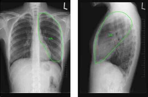 Left Upper Lobe – Anatomy – Toronto Notes