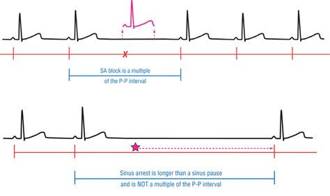 sinus-block-arrest - Cardiac Sciences Manitoba